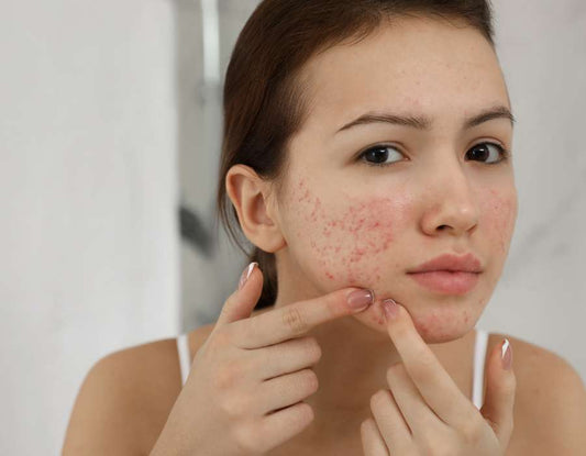 Masque pour peau acnéique - Purifiant & Matifiant